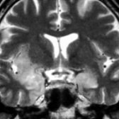 Coronal T2 MR in a patient with limbic encephalitis shows abnormal hyperintensity in the medial temporal lobes and right insula  in this patient with severe memory loss and dementia. Symptoms improved after the removal of the primary tumor.