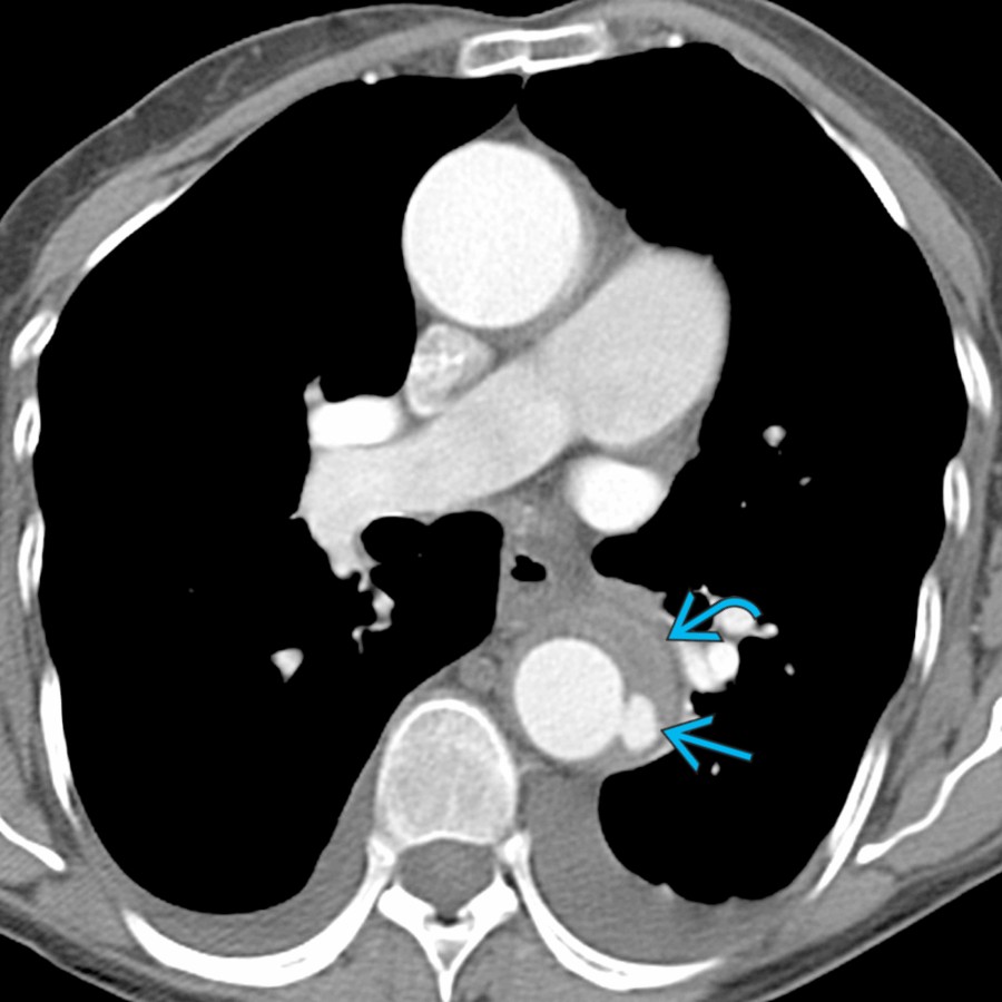 Axial CECT in a patient with type B IMH  shows focal aortic projection    consistent with ULP. This collection was not present on the baseline CTA but developed on follow-up imaging.