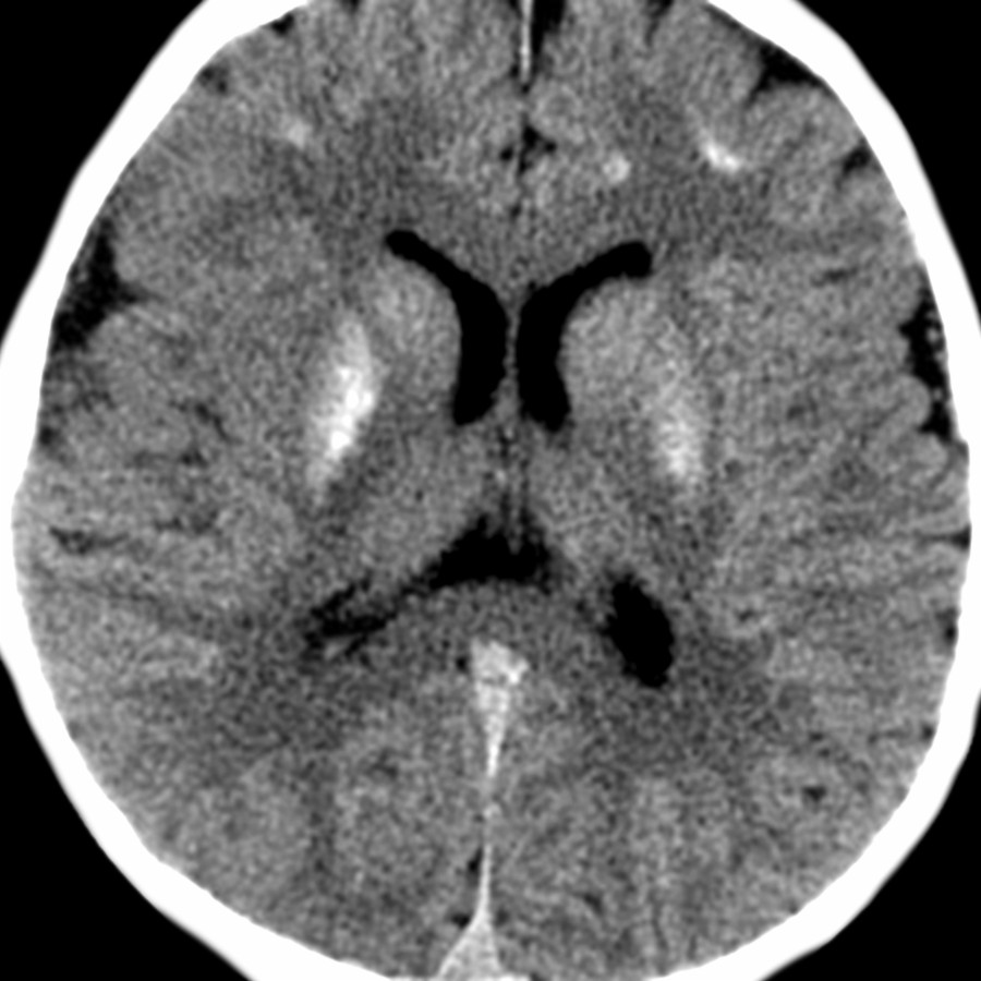 Axial NECT shows diffuse calcifications within the BG & subcortical WM in a pseudohypoparathyroidism patient. There is significant imaging overlap between systemic diseases with abnormal calcium deposition.