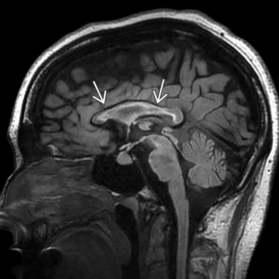 Sagittal FLAIR MR in a patient with chronic MS demonstrates diffuse thinning of the corpus callosum     with extensive abnormal T2 hyperintensity along the callosal-septal interface, reflecting chronic demyelinating disease.