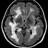 Axial FLAIR MR shows confluent periventricular WM hyperintensity typical of advanced, longstanding MS with loss of discrete, linear, periventricular lesions.