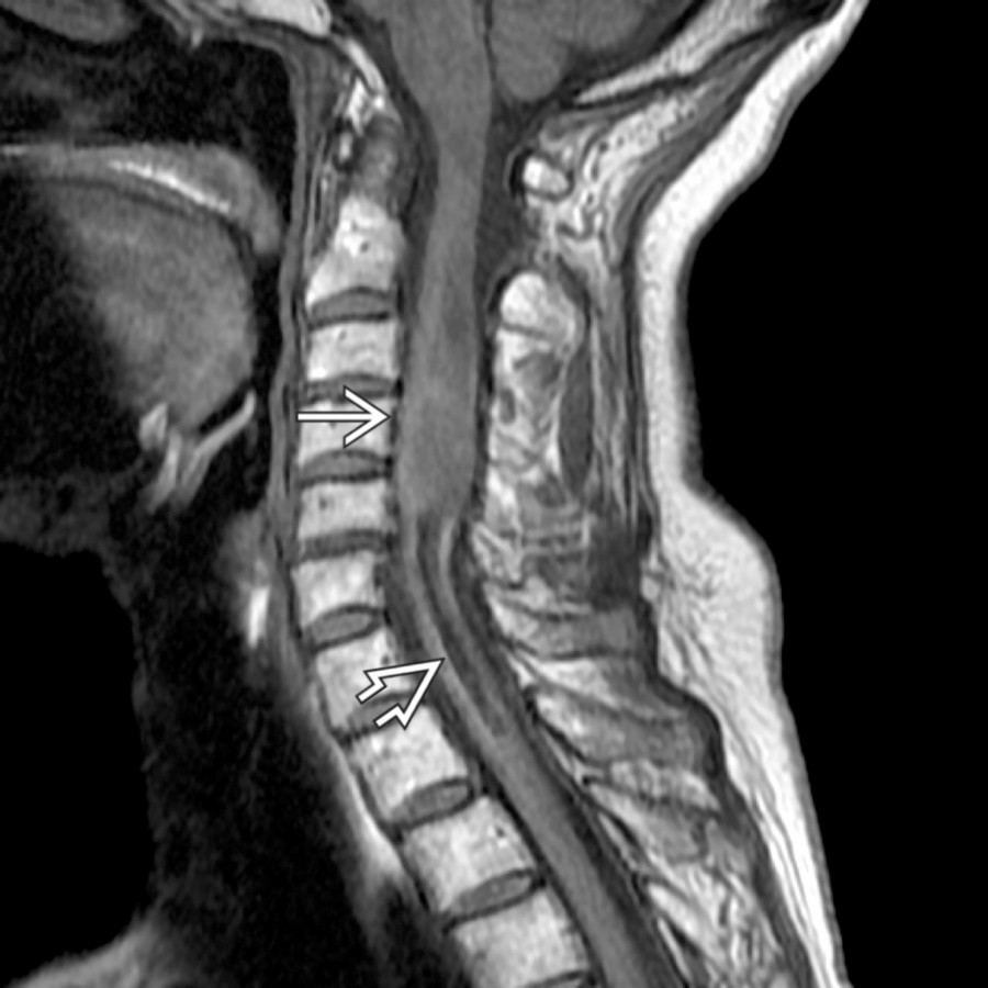 Sagittal T1 MR shows expansion of the cervical cord with an isointense mass at the C3-C5 level   with a large linear area of low-signal hemorrhage extending inferiorly within the cord .