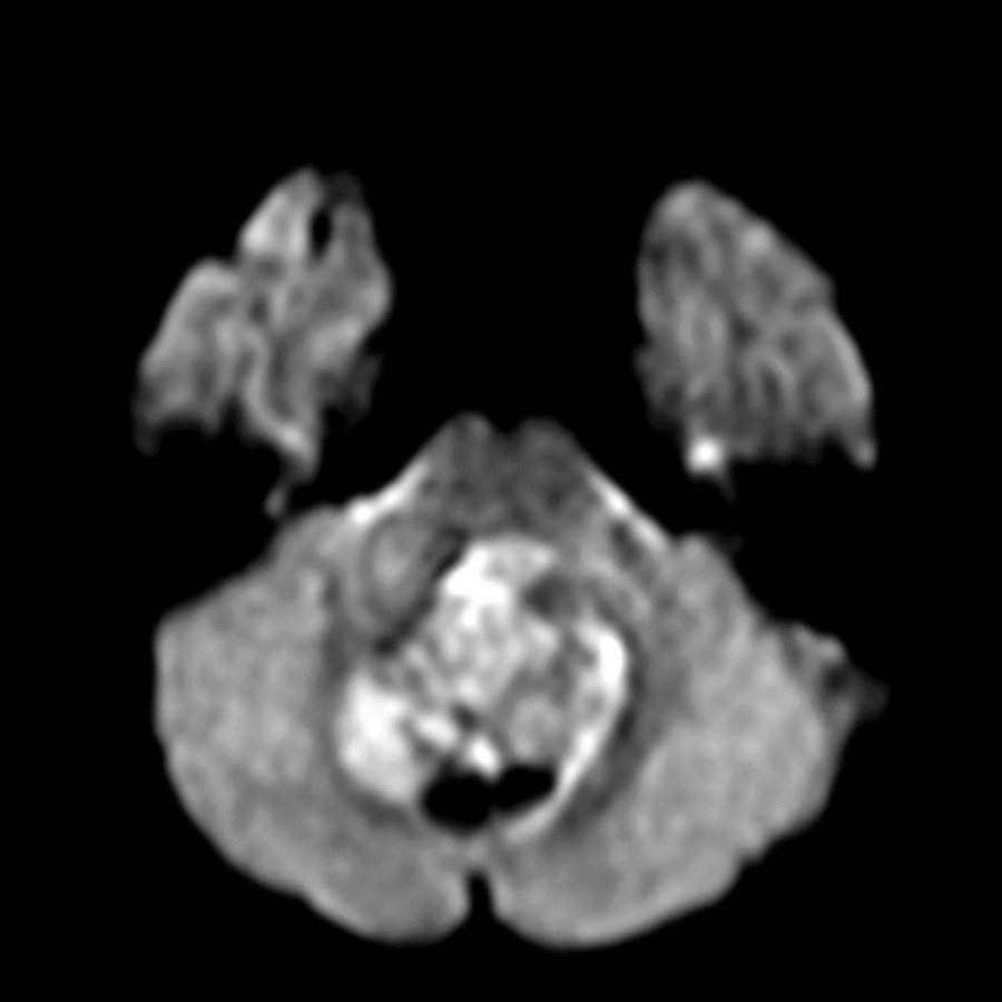 Axial DWI MR shows areas of decreased diffusion in this WNT pathway medulloblastoma. Decreased diffusion is typical for all medulloblastomas and high- grade neoplasms.