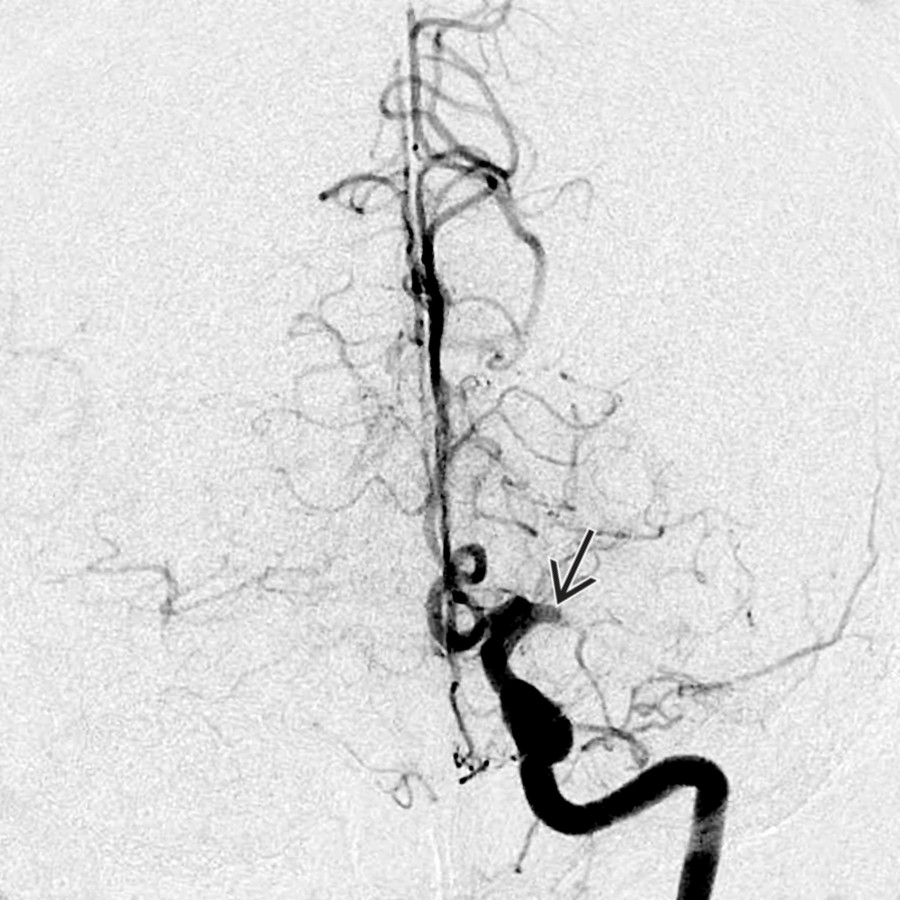Anteroposterior view of DSA shows abrupt occlusion of the left MCA just distal to its origin  in a patient with a sudden onset of right-sided weakness and stroke-like symptoms. Little collateral filling of the distal MCA is seen.