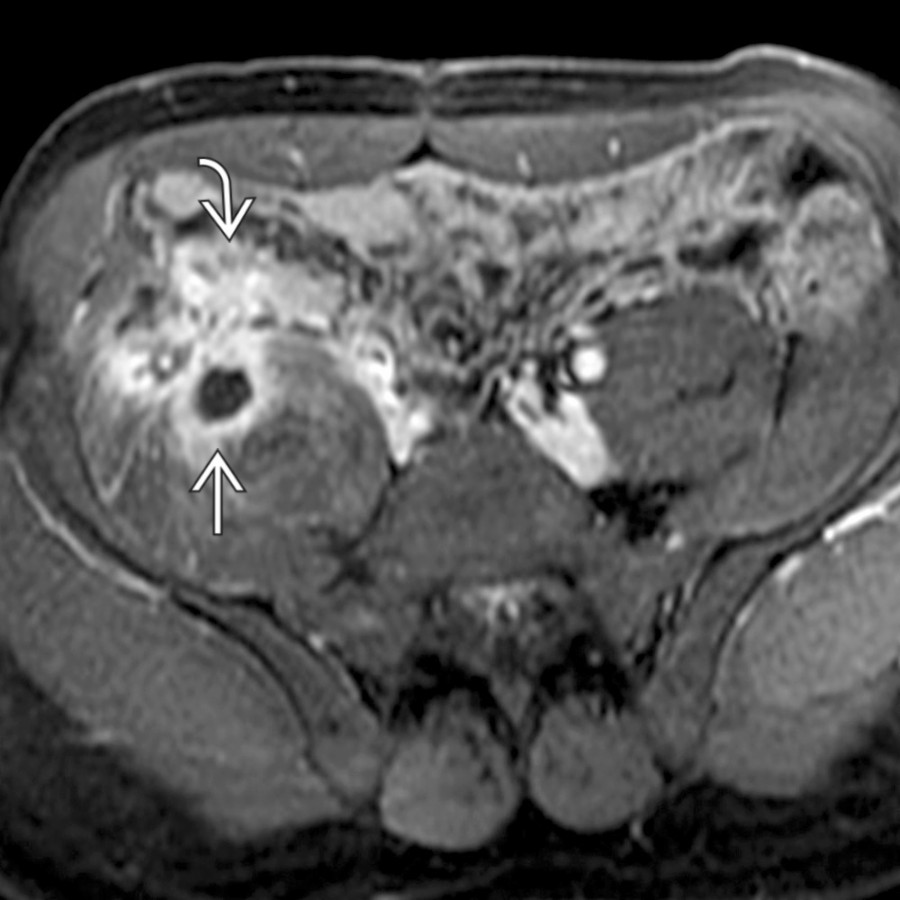 Axial T1 C+ MR shows an abscess  in the iliopsoas muscle directly contiguous with phlegmonous change  in the right lower quadrant due to the patient's fistulizing Crohn disease.