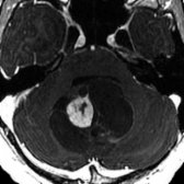 Axial T1 C+ SPGR MR shows a pilocytic astrocytoma with enhancing, eccentric nodule . There is cyst wall enhancement  (present in ~ 50% of cases). Note obstructive hydrocephalus with dilation of superior 4th ventricle  secondary to mass effect.