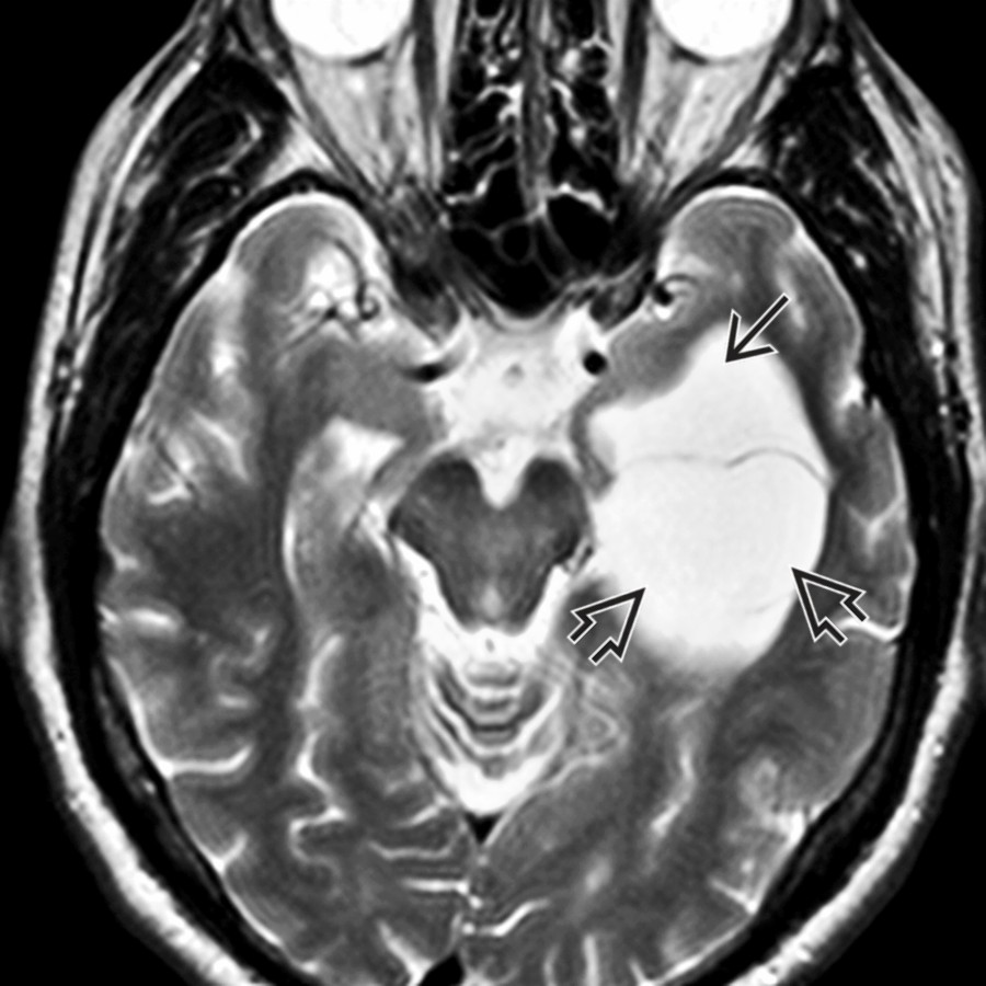 Axial T2WI MR demonstrates a well-defined CSF intensity cyst with the left temporal horn most consistent with an ependymal cyst . Note the dilated and trapped left temporal horn .