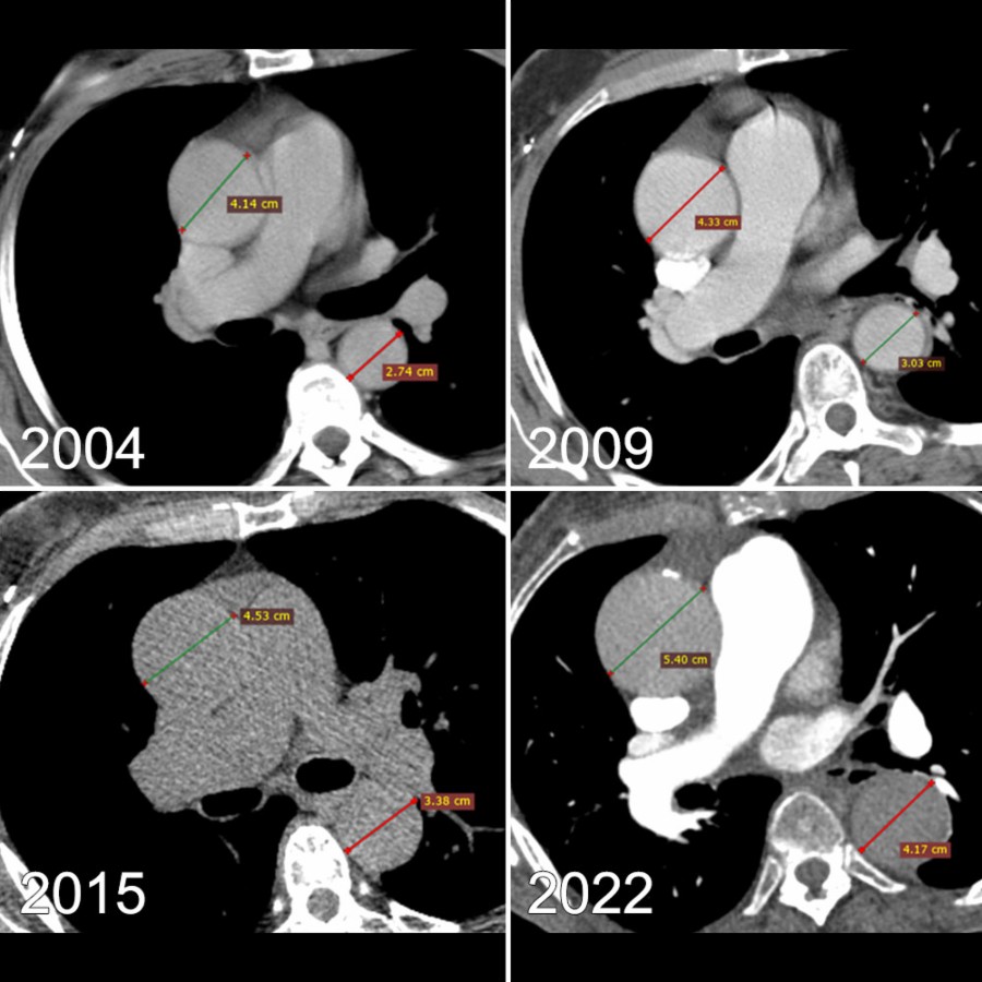 Axial CECT images from the years 2004, 2009, 2015, and 2022 are shown. The AA grew from 4.1 cm to 4.3 cm to 4.5 cm to 5.4 cm, respectively. Similarly, the DTA grew from 2.7 cm to 3 cm to 3.4 cm to 4.2 cm.