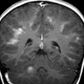 Coronal T1 C+ MR demonstrates partial peripheral enhancement around multiple asymmetric, flocculent lesions of acute disseminated encephalomyelitis. Note the supra- and infratentorial lesions.