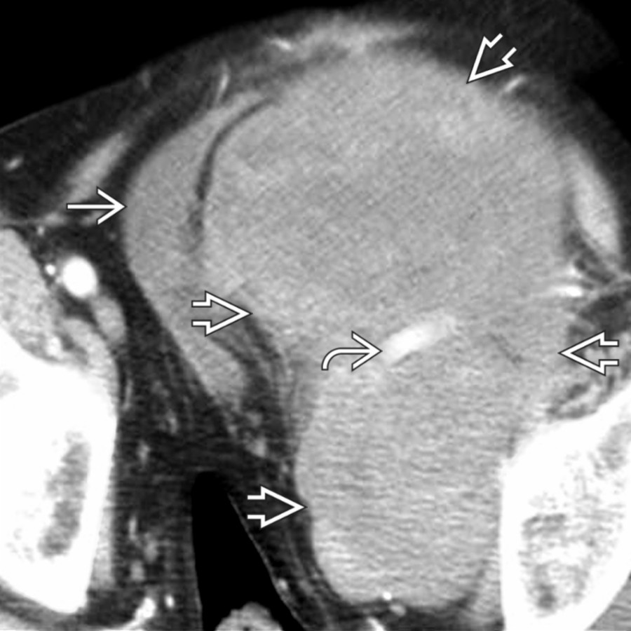 Axial CECT shows a large, heterogeneous tumor , which displaces the bladder  and external iliac artery . This is a leiomyosarcoma arising from the psoas muscle.