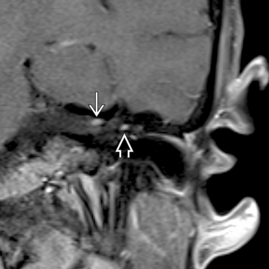 Coronal T1 C+ FS MR shows a classic "tuft" of enhancement at the superior fundus of the IAC  as well as along the tympanic segment  of the facial nerve in a patient with Bell palsy.