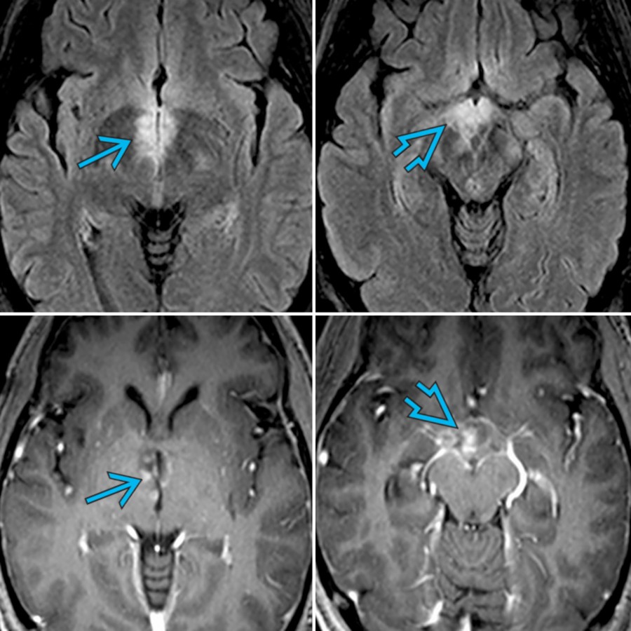 Axial FLAIR MR (top) and T1 C+ MR (bottom) in the same patient show hyperintense lesions with patchy enhancement in the periependymal region surrounding the 3rd ventricle , and the hypothalamus . Brain lesions in NMOSD are typically localized in the periependymal regions where AQP4 is highly expressed.
