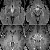 Axial FLAIR MR (top) and T1 C+ MR (bottom) in the same patient show hyperintense lesions with patchy enhancement in the periependymal region surrounding the 3rd ventricle , and the hypothalamus . Brain lesions in NMOSD are typically localized in the periependymal regions where AQP4 is highly expressed.