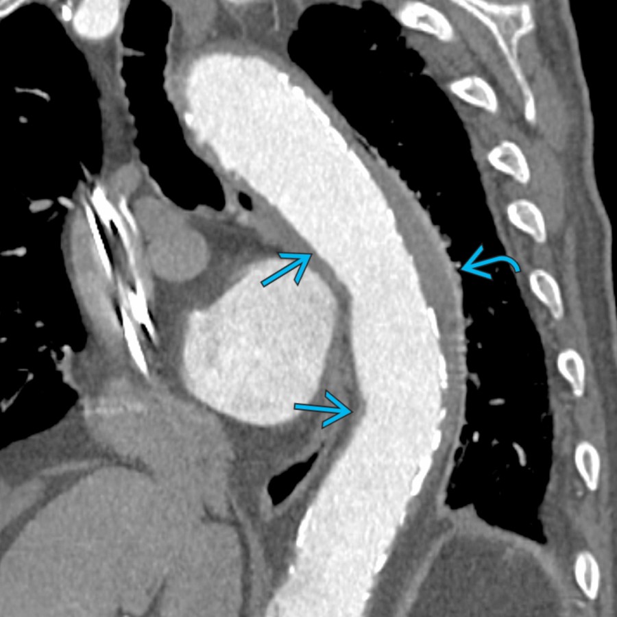Sagittal oblique CTA shows type B IMH . Note decreased diameter  of the aortic lumen along the area of IMH. This is a helpful finding to differentiate from aortitis, which usually does not exhibit such features.