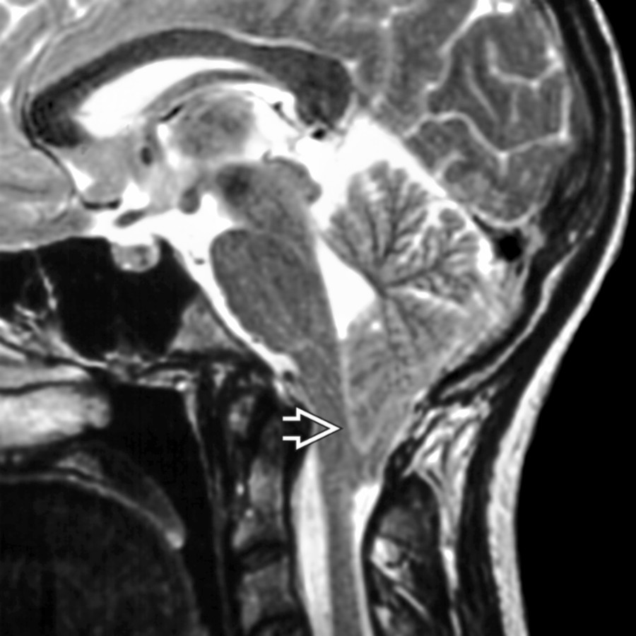 Sagittal T2WI MR shows a classic case of Chiari 1 with pointed cerebellar tonsils  protruding through the foramen magnum and effacing the cisterna magna.