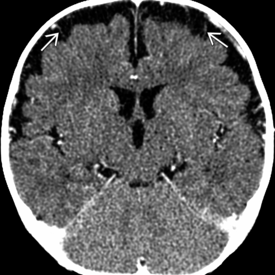 Axial CECT shows enlarged SAS with enhancing traversing veins  in a macrocephalic infant. This benign condition usually peaks at 7 months of age & resolves spontaneously by 12-24 months of age.