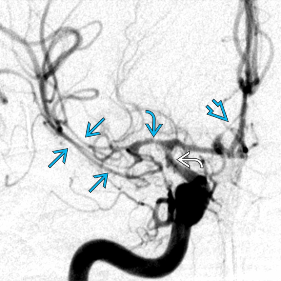 AP right ICA DSA in a patient with SAH in right sylvian & anterior interhemispheric fissures shows severe vasospasm in the right MCA M1  & M2  segments & in the right ACA A2 segment   & carotid terminus .