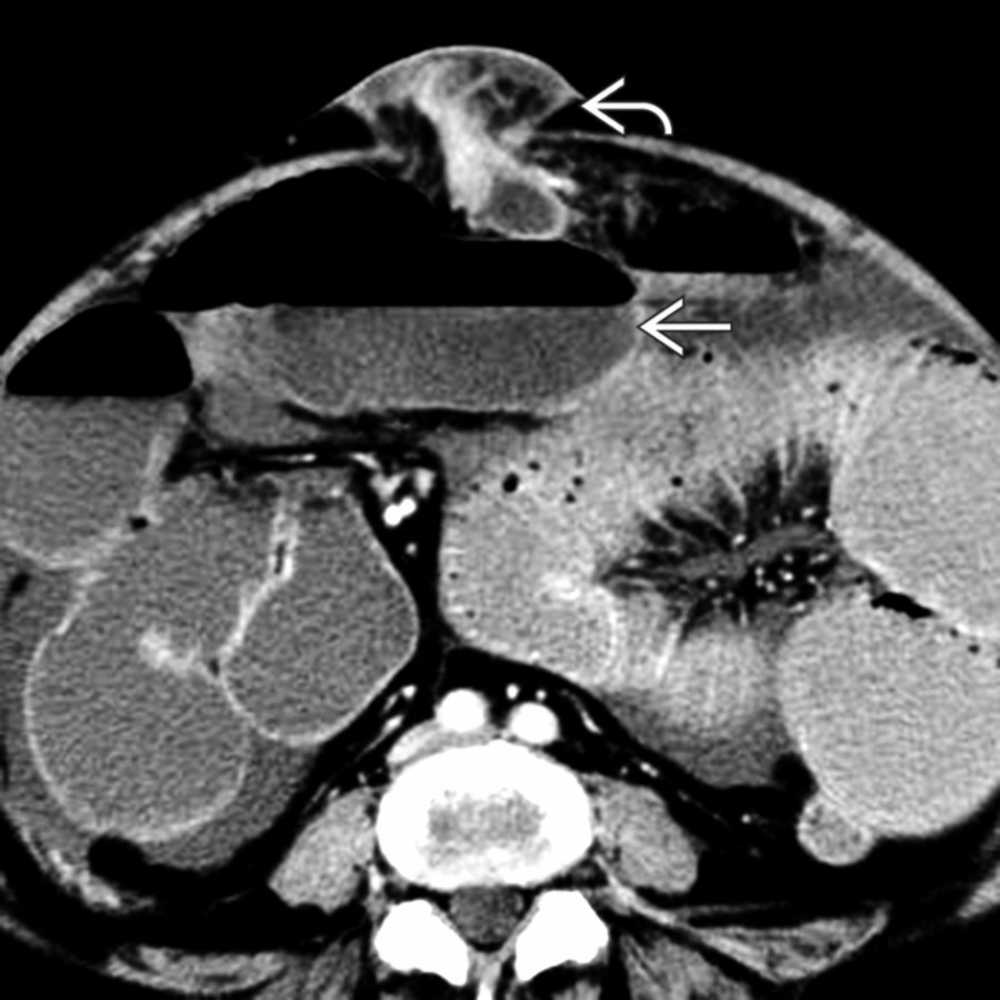 Axial CECT in a middle-aged man with cirrhosis shows ascites, a dilated small bowel , and an umbilical hernia  containing ascites and small bowel.