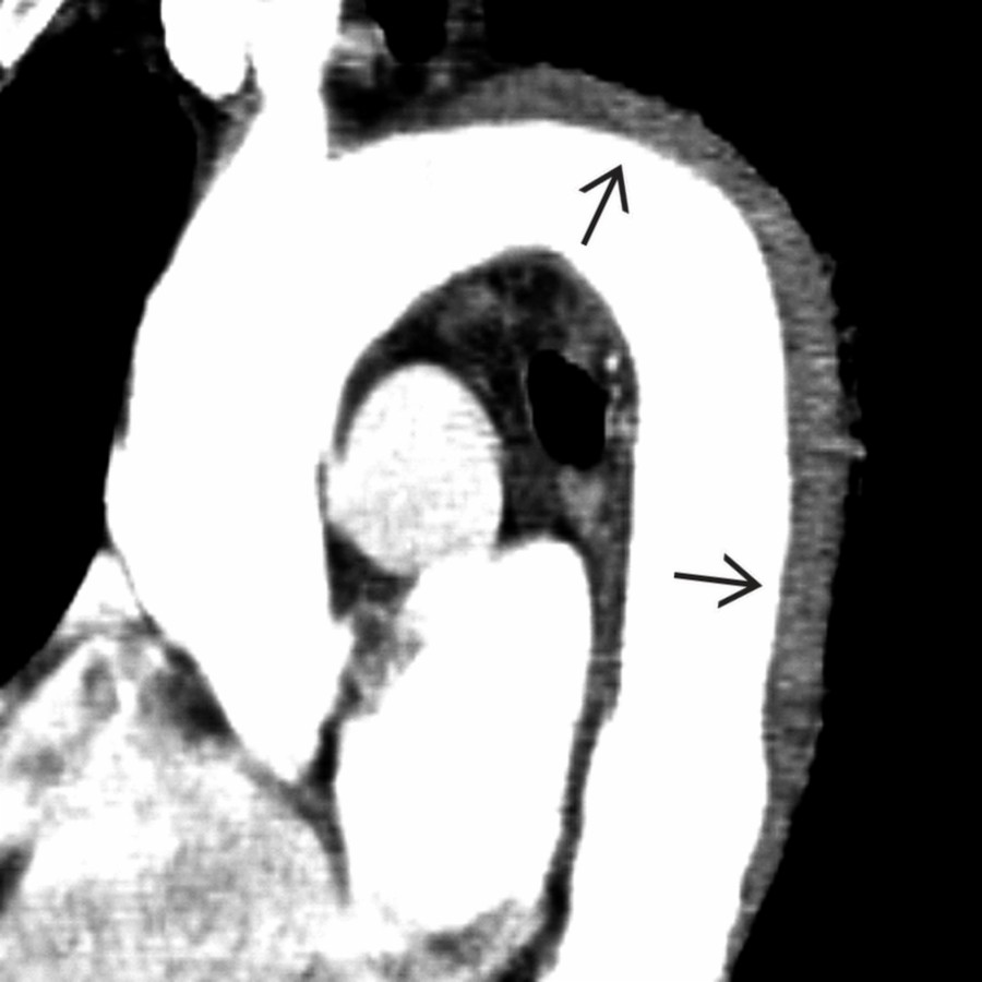 Sagittal oblique CTA in the same patient shows IMH  extending from the distal aortic arch into the descending thoracic aorta. Note the mild aortic luminal narrowing of the affected area when compared with the normal descending aorta. This latter feature may be helpful when differentiating IMH from incomplete dissection with subadventitial hemorrhage.