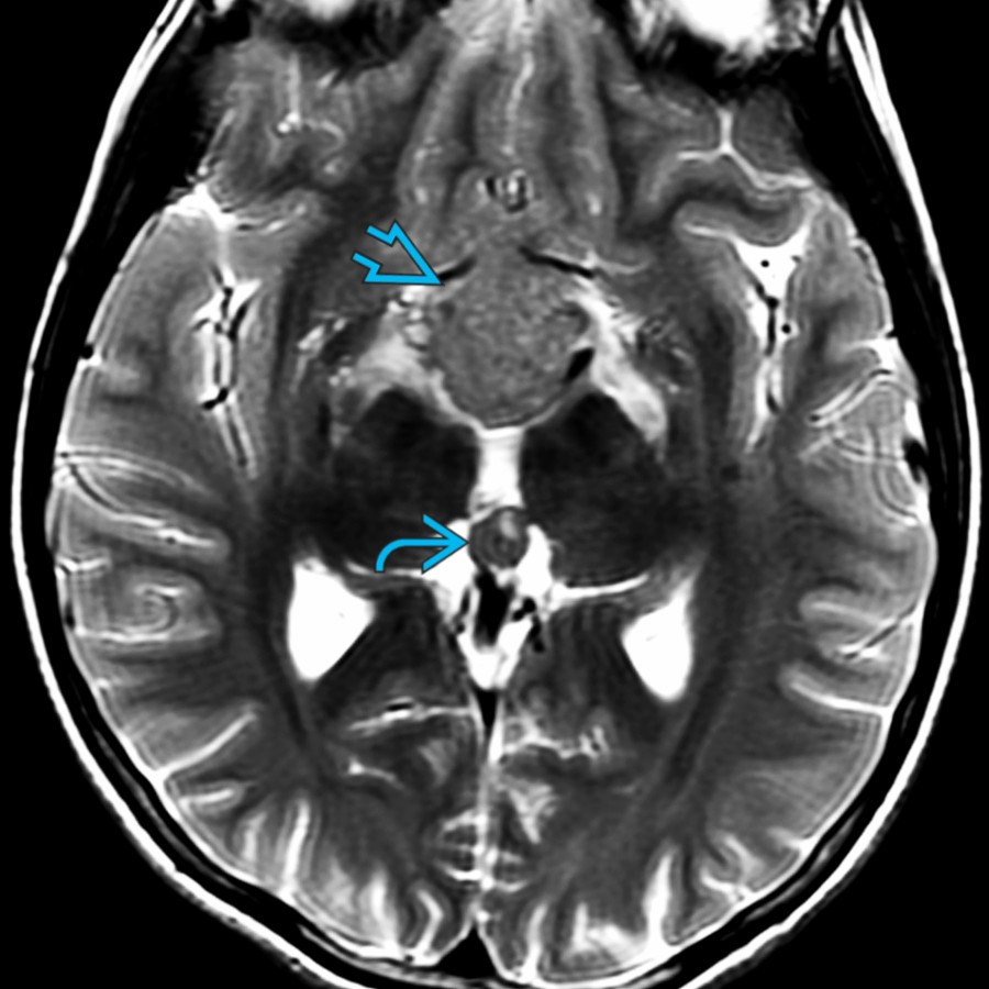 Axial T2 MR shows a mass in the suprasellar  and pineal  region in a teenage male patient with visual symptoms. The low signal is related to a high nuclear:cytoplasmic ratio.