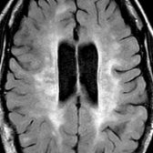 Axial FLAIR in a 35-year-old woman with MS shows extensive confluent periventricular hyperintense lesions , typical of advanced, longstanding MS with loss of discrete, linear, periventricular lesions. Note prominence of the ventricles and cortical sulci due to diffuse atrophy.