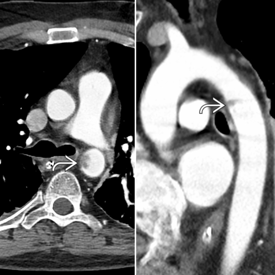 Axial (left) and sagittal (right) CTA in a patient with blunt chest trauma show a minimal aortic injury manifesting with a focal intimal flap  in the descending aorta without mediastinal hemorrhage.