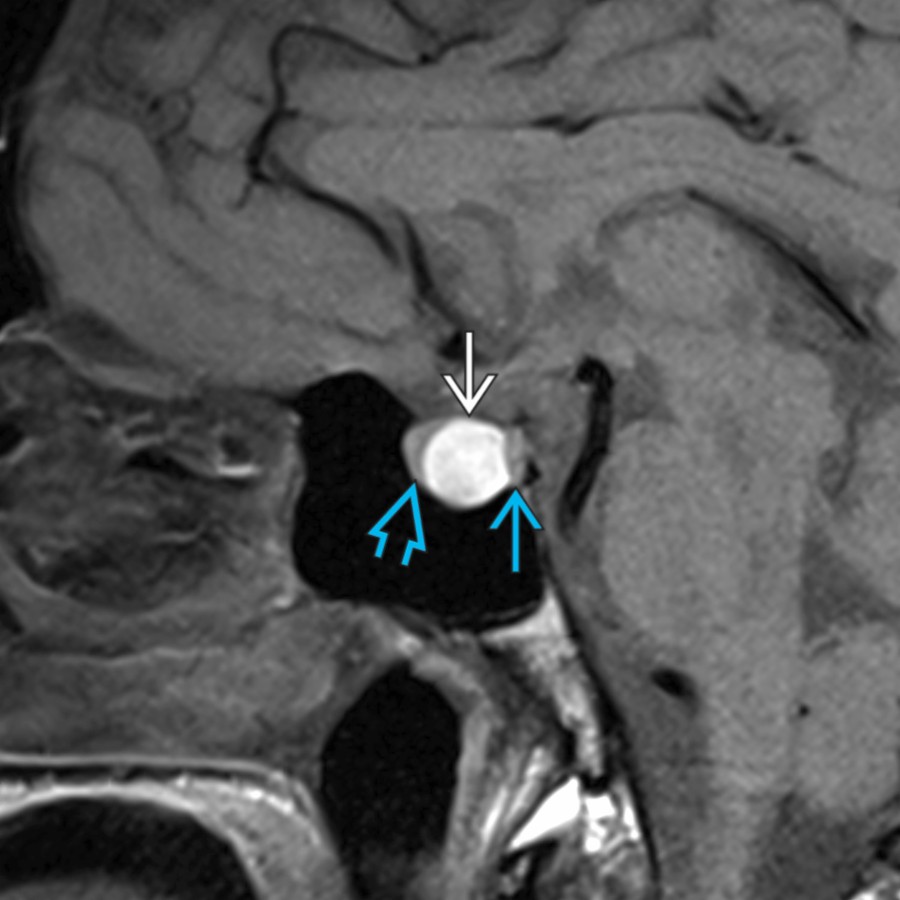 Sagittal T1 MR shows an intrinsic hyperintense lesion  within the pituitary gland between the adenohypophysis anteriorly  and the neurohypophysis posteriorly  related to a proteinaceous Rathke cleft cyst. An intracystic nodule may be seen in these benign cystic lesions.