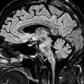 Sagittal FLAIR in the same patient obtained a year later when symptoms relapsed off steroids shows multiple punctate hyperintensities "peppering" the pons  and medulla . Note extension into upper spinal cord .