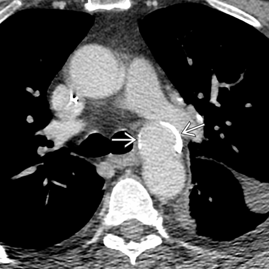 Axial chest CTA in the same patient demonstrates well-marginated saccular dilatation  of the aorta at the level of the isthmus.
