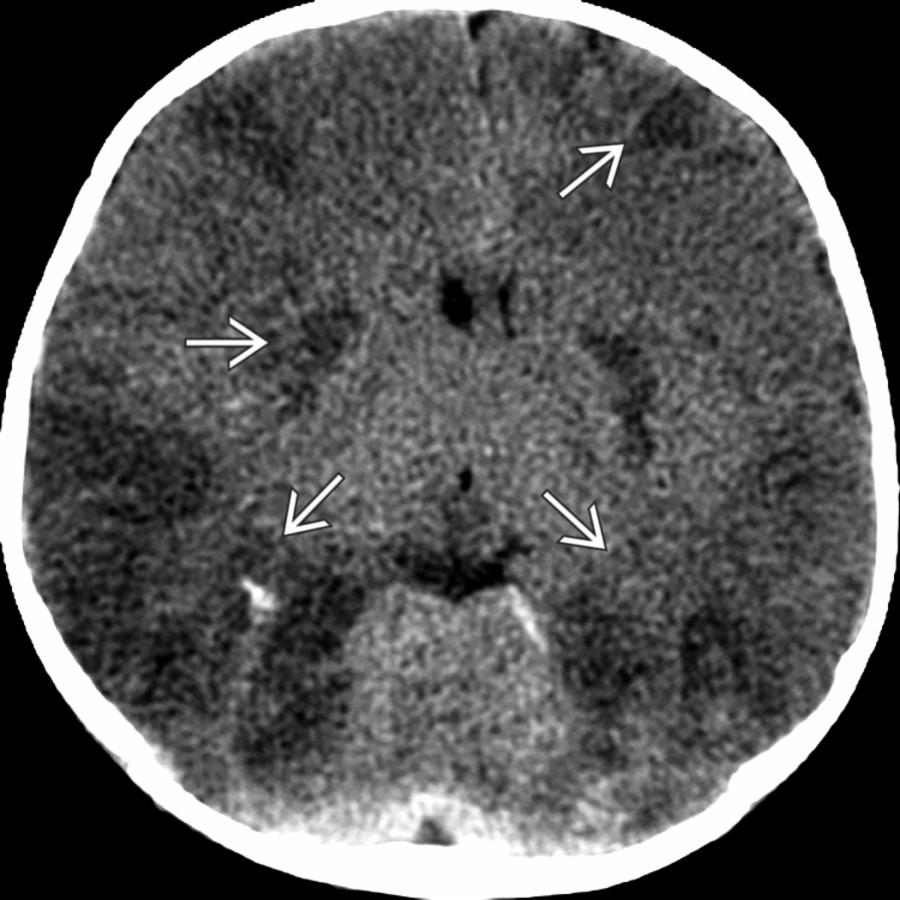 Axial NECT in the same child 12 hours later shows the rapid development of multiple regions of cytotoxic edema    with effacement of the 3rd ventricle & cisterns.