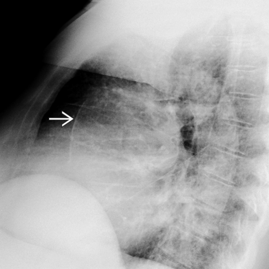 Lateral radiograph shows diffuse aortic calcifications  in a patient with longstanding hypertension and a dilated ascending aorta.