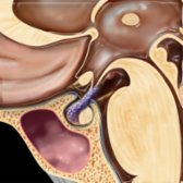 Sagittal graphic shows lymphocytic hypophysitis (LH). Note thickening of the infundibulum with loss of the normal "top to bottom" tapering as well as infiltration into the anterior lobe of the pituitary gland .