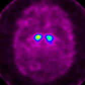 I-123 ioflupane scan demonstrates significant abnormally decreased activity in the putamen bilaterally   as can be seen in LBD, Parkinson disease, and parkinsonian syndromes.