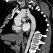 Aortic arch "candy cane" view of CTA shows separation of the aortic arch into 2 distinct vessels (*). The superior is the normal 4th aortic arch giving rise to the arch vessels. The inferior is the persistent 5th aortic arch.