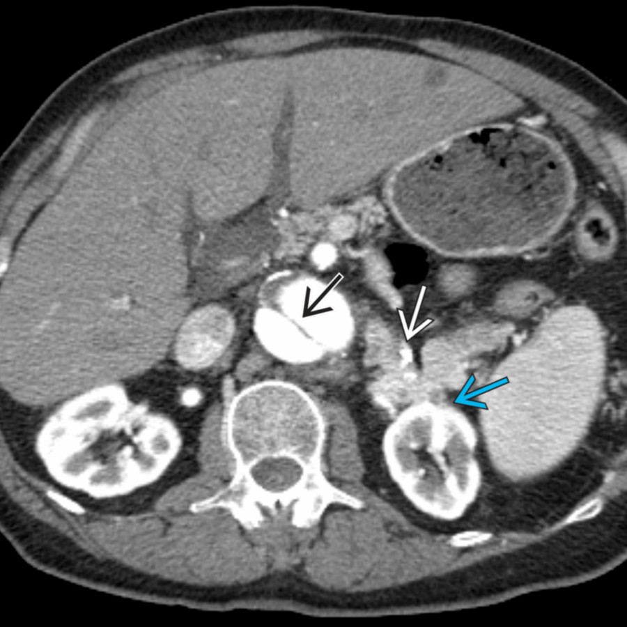 Axial CECT in a 79-year-old man with locally recurrent pheochromocytoma shows an irregular, enhancing mass in the left adrenal fossa  abutting the anterior left kidney . Note incidental chronic aortic dissection .