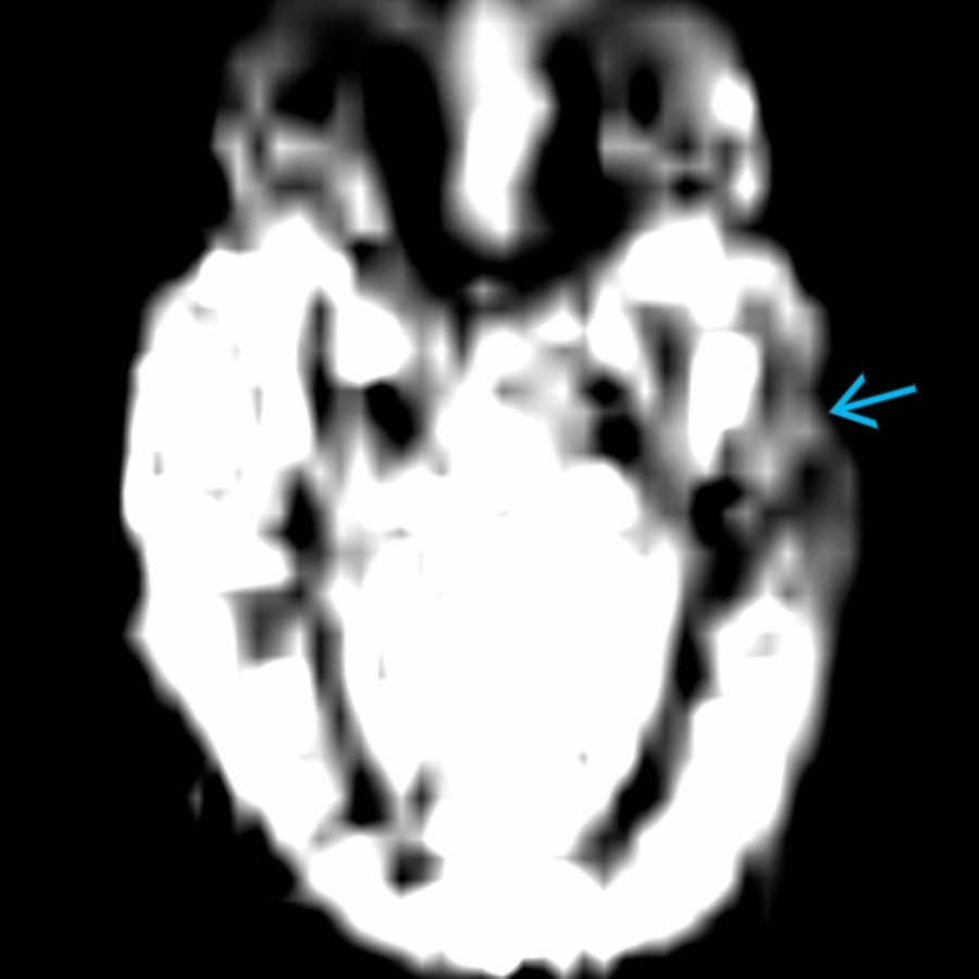 Axial CBF map from arterial spin labeling shows relative hypoperfusion of the left temporal lobe  compared to the right in this patient with left mesial temporal sclerosis. This is consistent with interictal seizure focus.