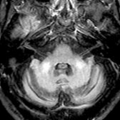 Axial FLAIR MR in the same patient shows decreased width of the middle cerebellar peduncles with symmetric hyperintensities , consistent with the MCP sign. This sign can be seen in a number of conditions, particularly neurodegenerative diseases, and is most commonly associated with FXTAS.