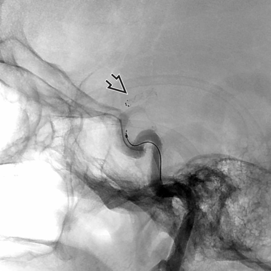 Lateral unsubtracted angiogram shows the Solitaire device  deployed across the left ICA terminus occlusion.