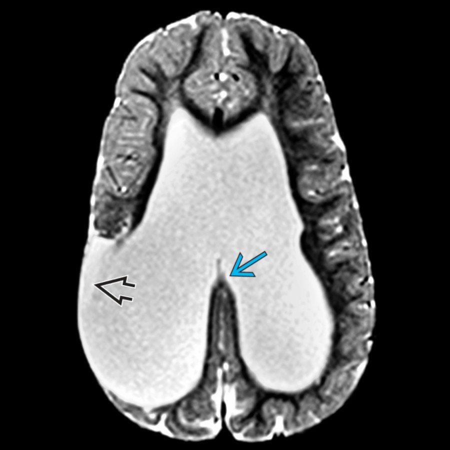 Axial T2 MR in the same child shows marked loss of the right periventricular parenchyma   at the site of a prior grade 4 hemorrhage. The posterior white matter loss correlates with the focal corpus callosum atrophy .