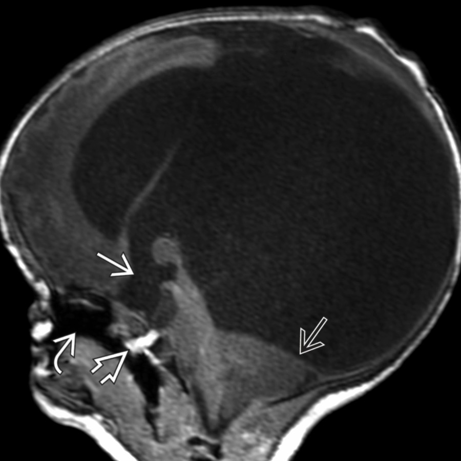 Sagittal T1 MR shows enlarged CSF space communicating from a displaced 3rd ventricle into a persistent infundibular recess . Note fat within a persistent craniopharyngeal canal , cleft palate , and downward herniation of the cerebellum  due to hydrocephalus from aqueductal stenosis.