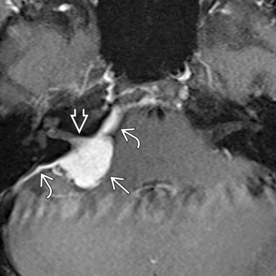 Axial T1 C+ FS MR shows the typical appearance of a CPA meningioma , which is avidly enhancing and extends into the IAC . Note the characteristic dural tails , which help differentiate meningioma from schwannoma.