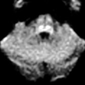 Axial DWI MR shows oval hyperintensities corresponding to CSTs in the pons . DWI/DTI can help differentiate progressive muscular atrophy [no change in fractional anisotropy (FA) or mean diffusivity (MD)] from ALS (↑ MD, ↓ FA), which can be clinically difficult.