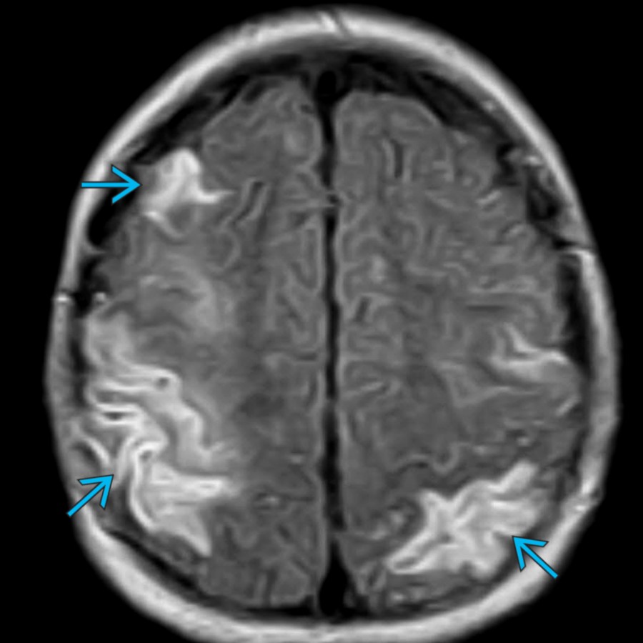 Axial FLAIR MR in a 2-year-old girl shows multiple areas of cytotoxic edema  in both cerebral hemispheres in this patient with moyamoya-type vasculopathy.