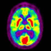 More inferior axial F-18 FDG PET in the patient with late-stage AD shows severe hypometabolism of the temporal  and frontal  cortices. Importantly, there is characteristic sparing of the basal ganglia  and visual cortex .
