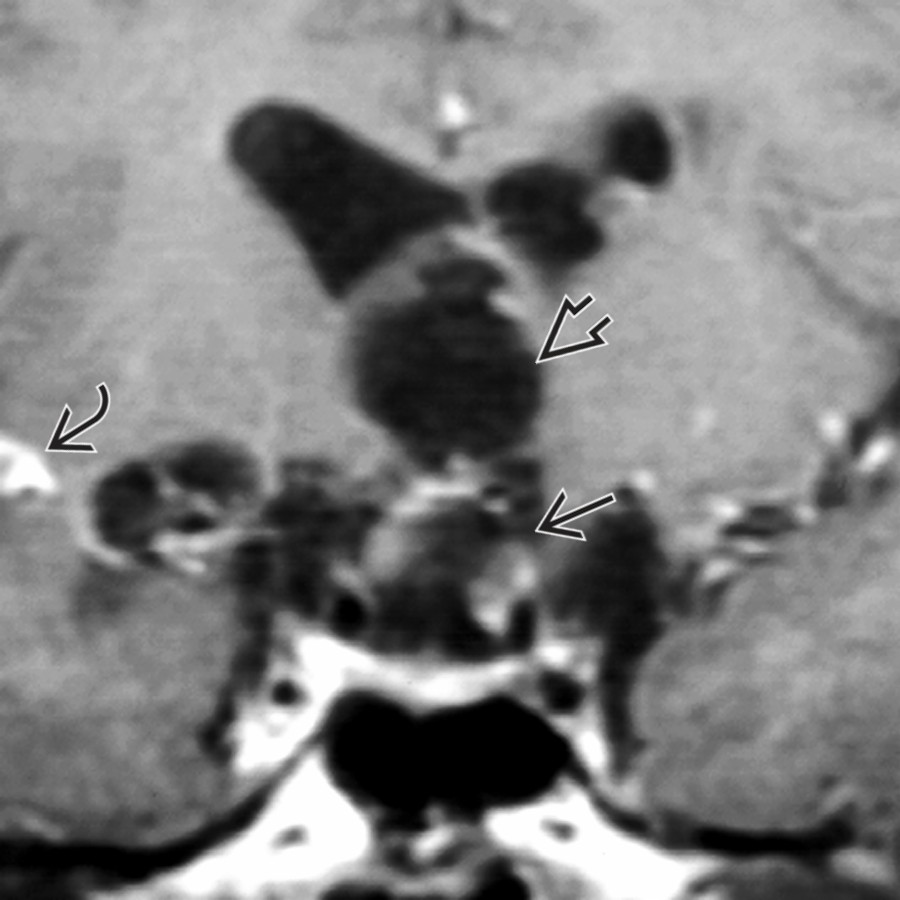 Coronal T1 C+ MR shows racemose neurocysticercosis with multiple cysts in the suprasellar cistern  and 3rd ventricle . Enhancement  in the right sylvian fissure is present.