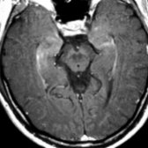 Axial T1 C+ MR shows subtle patchy enhancement of the medial temporal lobes bilaterally , which is a typical enhancement pattern for limbic encephalitis. Bilateral involvement is common.