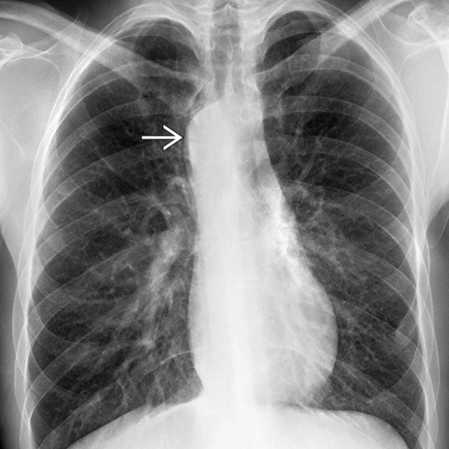 PA chest radiograph in an asymptomatic patient with RAA, ALSA, and KD shows RAA as a right paratracheal nodular opacity  with an indentation of the right tracheal margin.