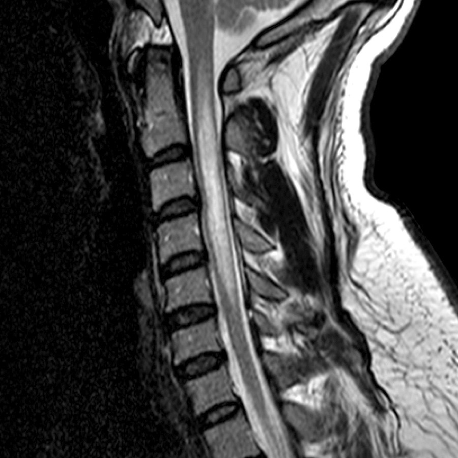 Sagittal T2 MR shows a longitudinally extensive region of increased signal intensity within the expanded cervical cord. Neuromyelitis optica lesions typically are > 3 vertebral body segments in length.