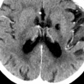 Axial CECT in 72-year-old woman with history of metastatic lung cancer & remote lacunar infarction in left basal ganglia & adjacent internal capsule shows a remote lacunar infarction in left gangliocapsular region .
