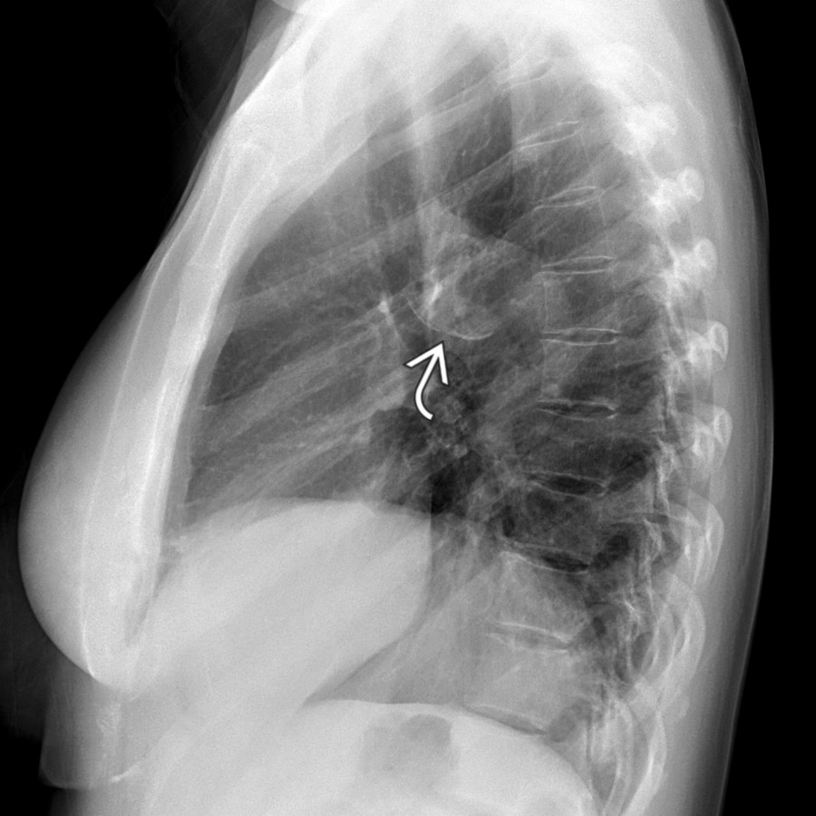 Lateral radiograph of the chest in the same patient shows aortic bulging with intrinsic mural calcification  at the isthmus.